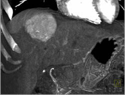 Focal Nodular Hyperplasia (FNH) - CTisus CT Scan