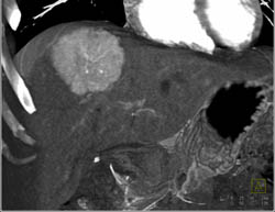 Focal Nodular Hyperplasia (FNH) - CTisus CT Scan