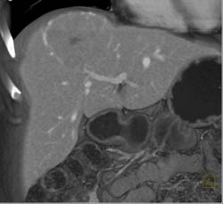 Focal Nodular Hyperplasia (FNH) - CTisus CT Scan