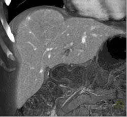 Focal Nodular Hyperplasia (FNH) - CTisus CT Scan