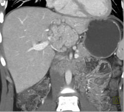 Focal Nodular Hyperplasia (FNH) - CTisus CT Scan