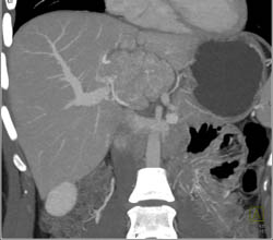 Focal Nodular Hyperplasia (FNH) - CTisus CT Scan