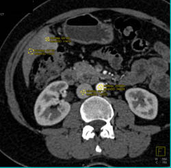 2 Cm Focal Nodular Hyperplasia (FNH) - CTisus CT Scan