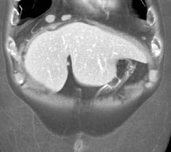 Para-cardiac Nodes - CTisus CT Scan