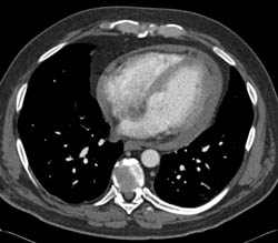 Pericardial Effusion and Perfusion Changes Liver - CTisus CT Scan