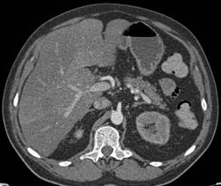 Lymphoma Involves the Liver and Left Kidney - CTisus CT Scan