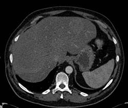 Pericardial Effusion With Hepatic Congestion - CTisus CT Scan