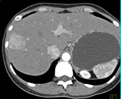 Focal Nodular Hyperplasia (FNH) - CTisus CT Scan