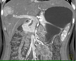 Focal Nodular Hyperplasia (FNH) - CTisus CT Scan