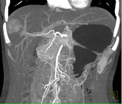 Focal Nodular Hyperplasia (FNH) - CTisus CT Scan