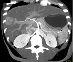 Focal Nodular Hyperplasia (FNH) - CTisus CT Scan