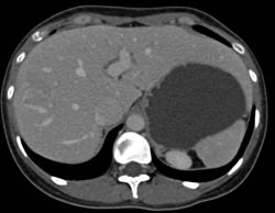 Focal Nodular Hyperplasia (FNH) - CTisus CT Scan