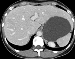 Focal Nodular Hyperplasia (FNH) - CTisus CT Scan