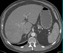 Subtle Hepatoma With Increased Vascularity on Early Phase Images- See Sequence- and Involvement of Portal Vein - CTisus CT Scan