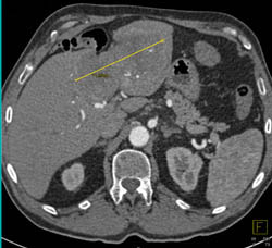 Cholangiocarcinoma - CTisus CT Scan