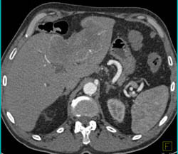 Cholangiocarcinoma - CTisus CT Scan