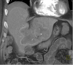 Cholangiocarcinoma - CTisus CT Scan