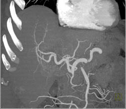 Cholangiocarcinoma - CTisus CT Scan