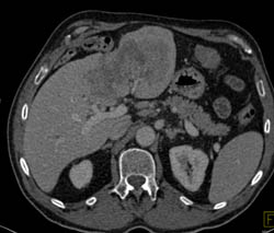 Cholangiocarcinoma - CTisus CT Scan