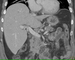 Cholangiocarcinoma - CTisus CT Scan