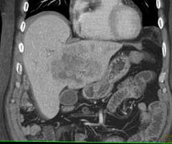 Cholangiocarcinoma - CTisus CT Scan