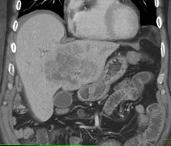 Cholangiocarcinoma - CTisus CT Scan