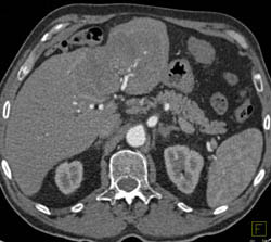 Cholangiocarcinoma - CTisus CT Scan