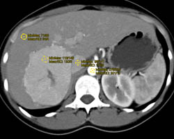 Focal Nodular Hyperplasia (FNH) - CTisus CT Scan