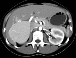 Focal Nodular Hyperplasia (FNH) - CTisus CT Scan