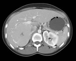 Focal Nodular Hyperplasia (FNH) - CTisus CT Scan