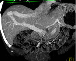 Hepatic Portal Vein Fistulae - CTisus CT Scan