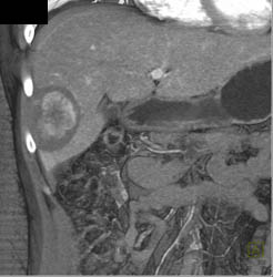 Hepatic Adenoma - CTisus CT Scan