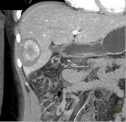 Hepatic Adenoma - CTisus CT Scan