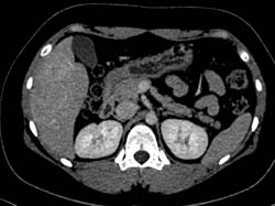 Hepatic Adenoma - CTisus CT Scan