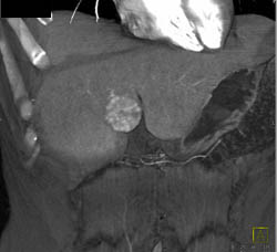 Hepatic Adenoma - CTisus CT Scan