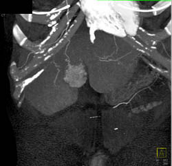 Focal Nodular Hyperplasia (FNH) - CTisus CT Scan