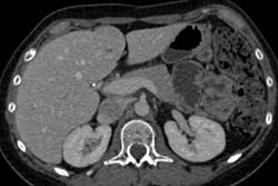 Focal Nodular Hyperplasia (FNH) - CTisus CT Scan