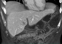 Focal Nodular Hyperplasia (FNH) - CTisus CT Scan