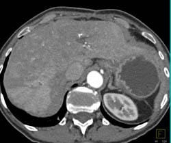 Atypical Focal Nodular Hyperplasia (FNH) - CTisus CT Scan