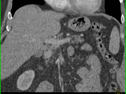 Focal Nodular Hyperplasia (FNH) - CTisus CT Scan