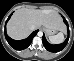 Focal Nodular Hyperplasia (FNH) - CTisus CT Scan