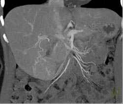 Focal Nodular Hyperplasia (FNH) - CTisus CT Scan