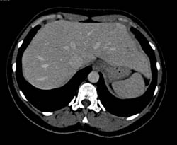 Focal Nodular Hyperplasia (FNH) - CTisus CT Scan