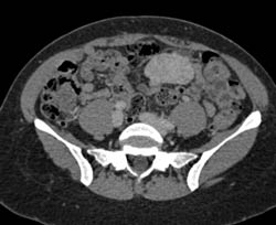 Focal Nodular Hyperplasia (FNH) - CTisus CT Scan