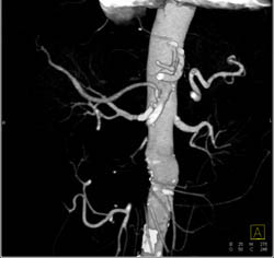 Focal Nodular Hyperplasia (FNH) - CTisus CT Scan