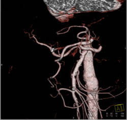 Focal Nodular Hyperplasia (FNH) - CTisus CT Scan