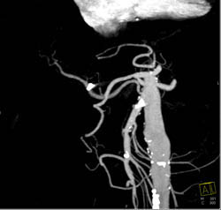 Focal Nodular Hyperplasia (FNH) - CTisus CT Scan