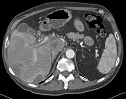 Metastatic Renal Cell Carcinoma to Liver and Portocaval Nodes - CTisus CT Scan