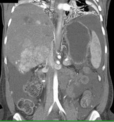 CTA Liver That Is Infiltrated By Tumor and Chemoembolization for Hepatoma - CTisus CT Scan