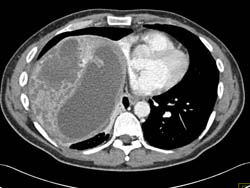 Biliary Cystadenocarcinoma - CTisus CT Scan